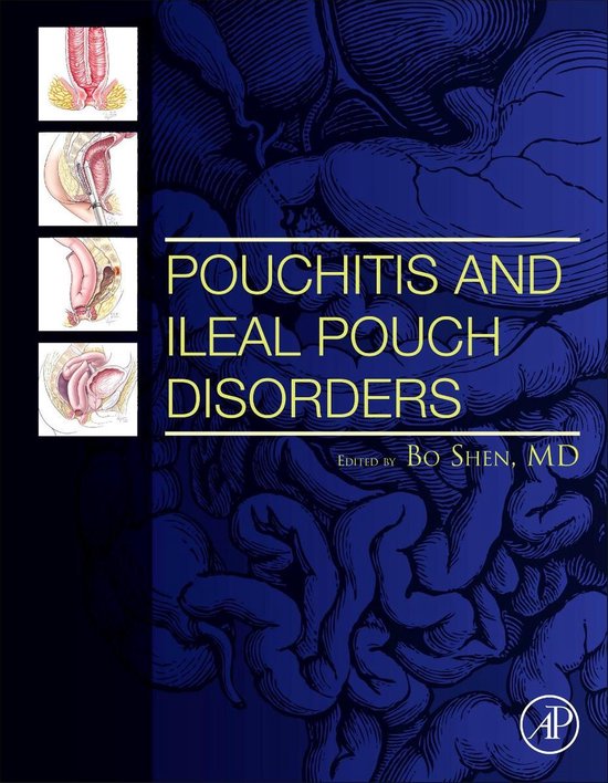 9780128094020-Pouchitis-and-Ileal-Pouch-Disorders